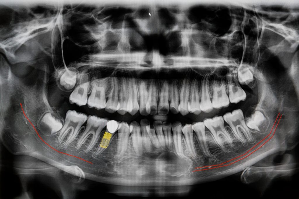 Digital x-ray of jaw with implant tooth