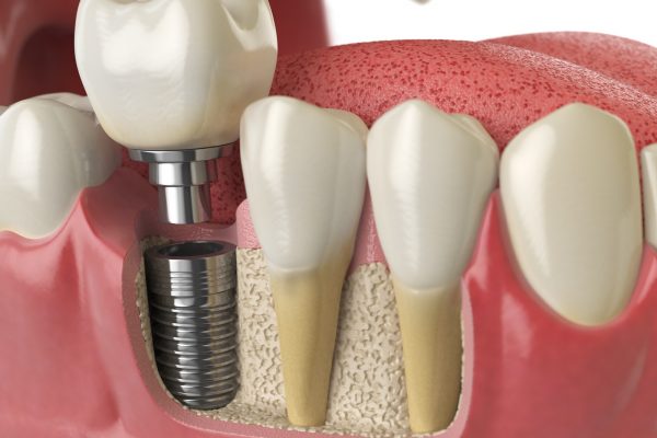 Anatomy of healthy teeth and tooth dental implant in human dentu