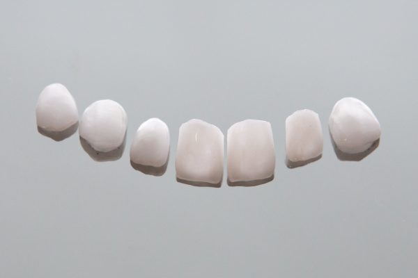 ceramic veneers